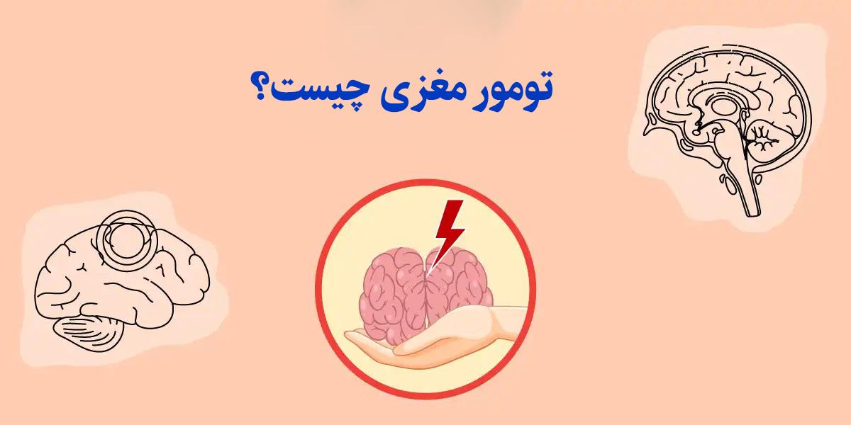 تومور مغزی چیست؟